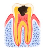 歯髄炎症